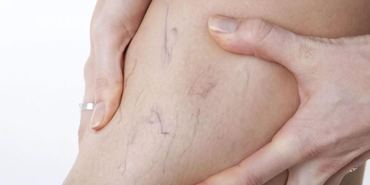 Before using Varicone cream