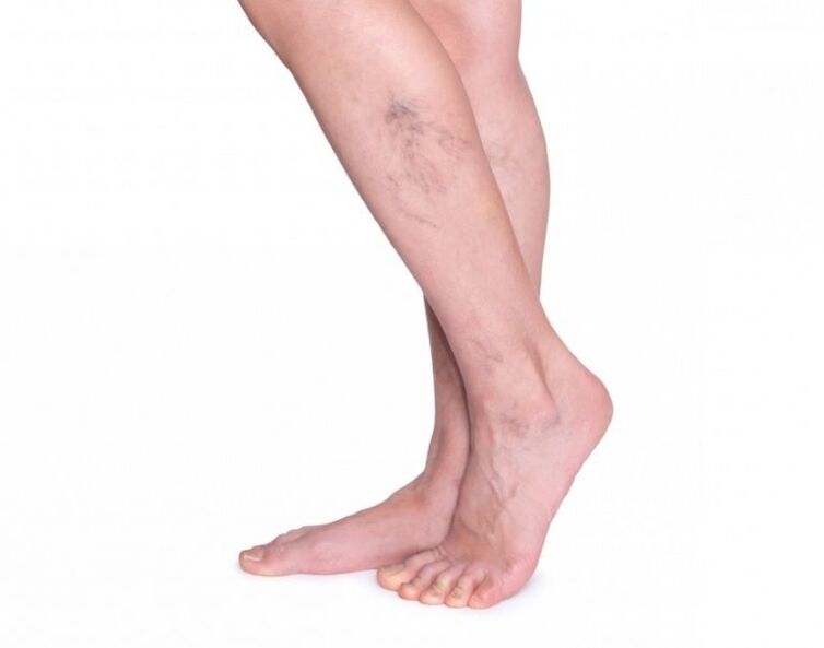 Varices before treatment with zxcvbnmqwort