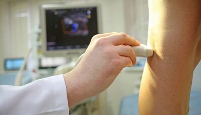 Varice laser treatment