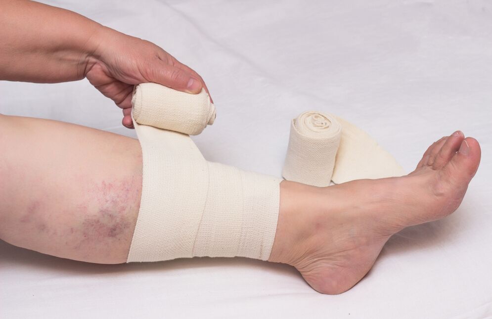 Varice compression treatment